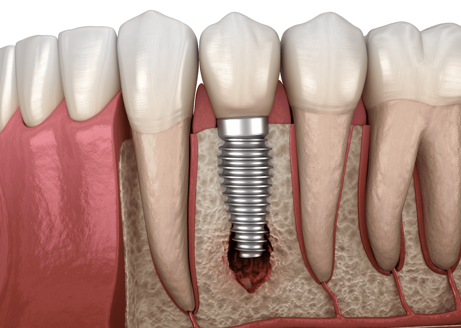 Ускладнення після імплантації