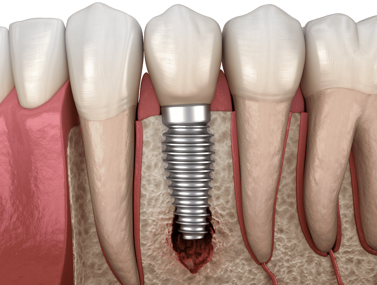 Відторгнення імпланту