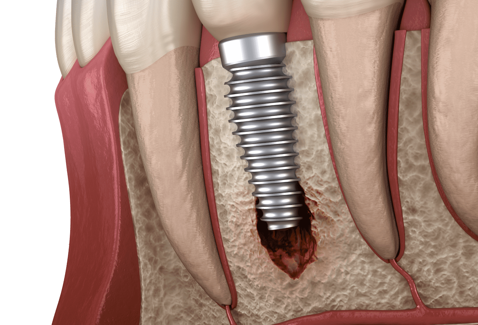 Первинні ускладнення після імплантації зубів