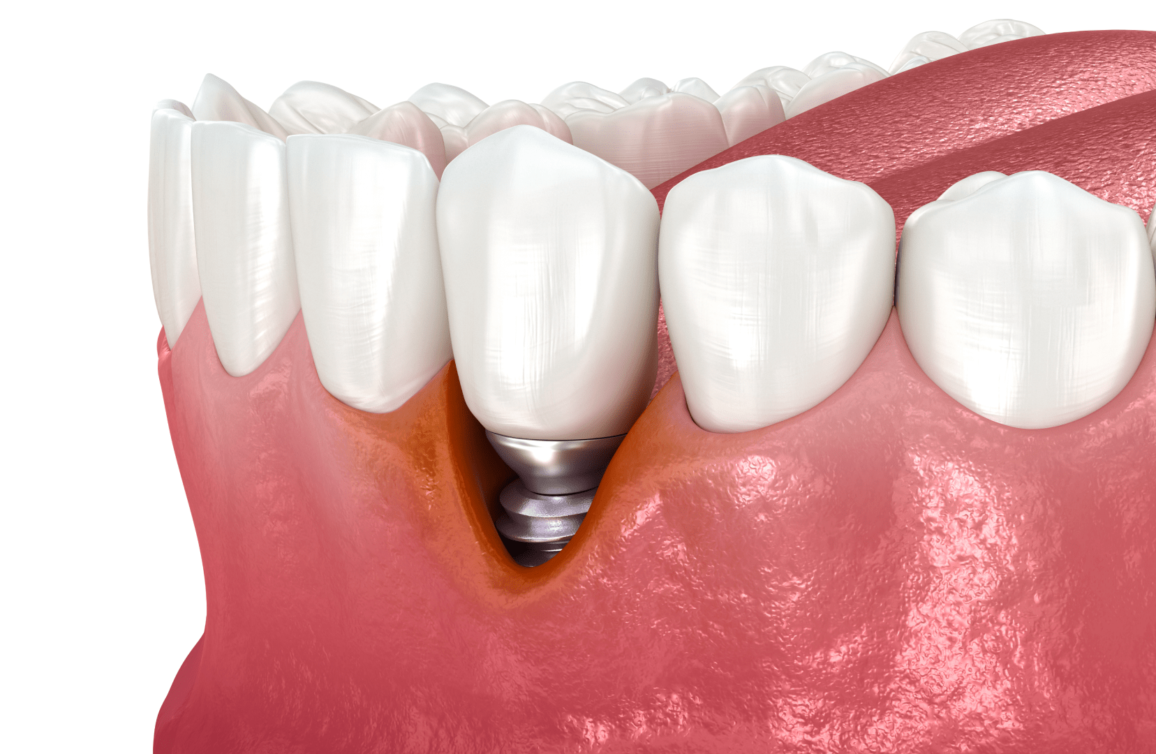 Пізні ускладнення після імплантації зубів
