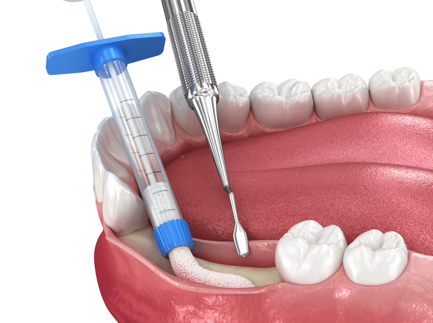 Нарощування кісткової тканини