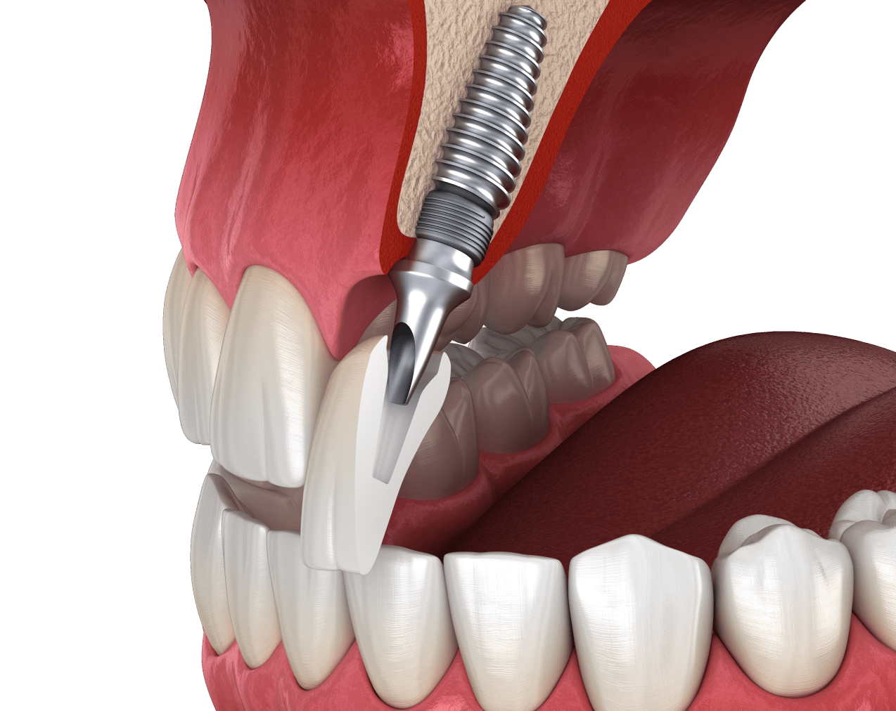 Приживання імплантів