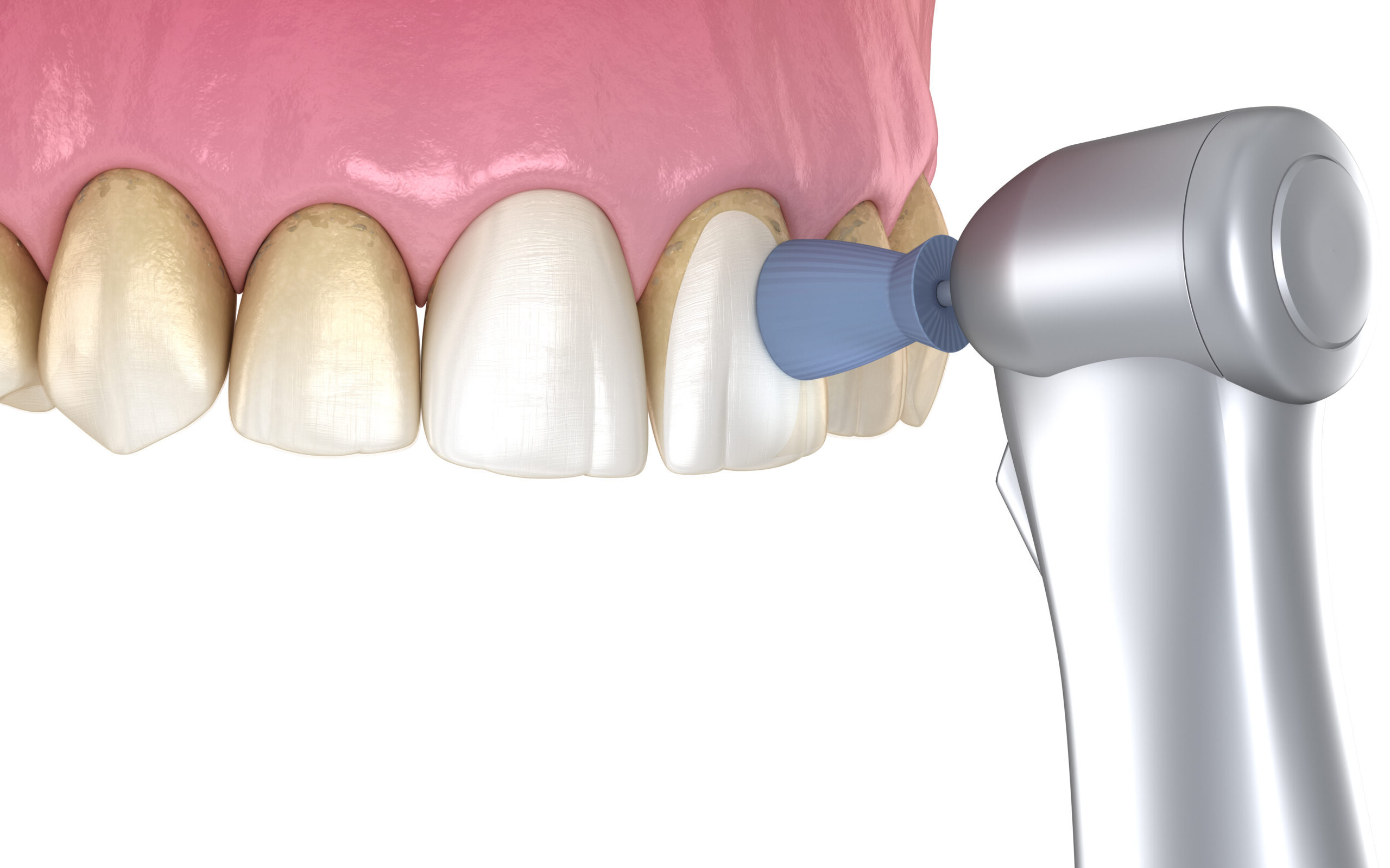 Професійне чищення зубів