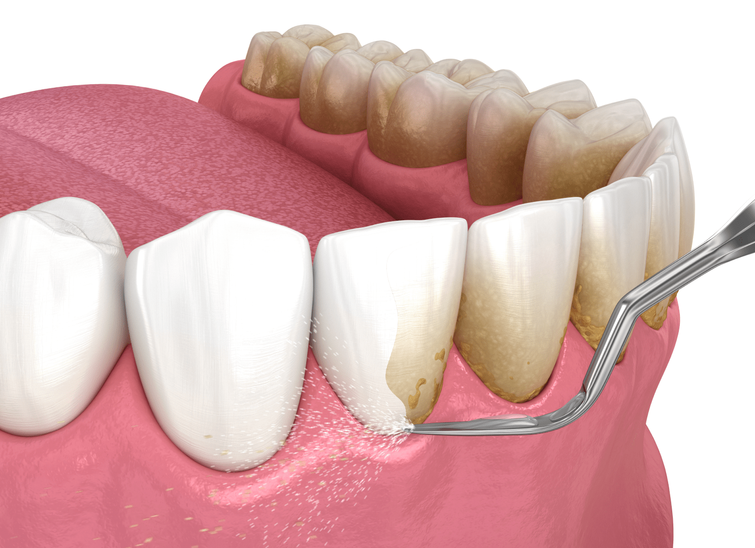Професійне чищення зубів