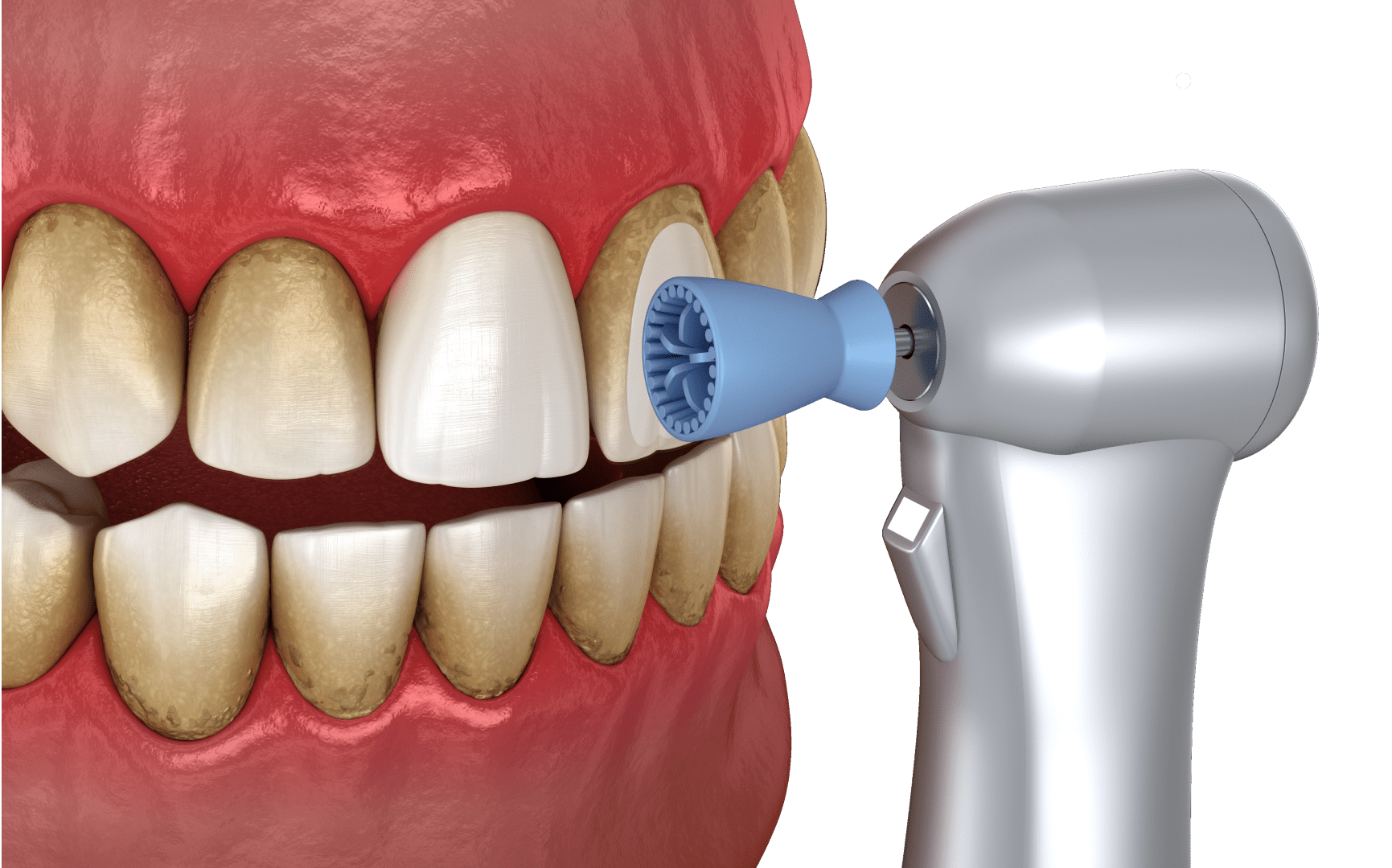 Профессиональная чистка зубов