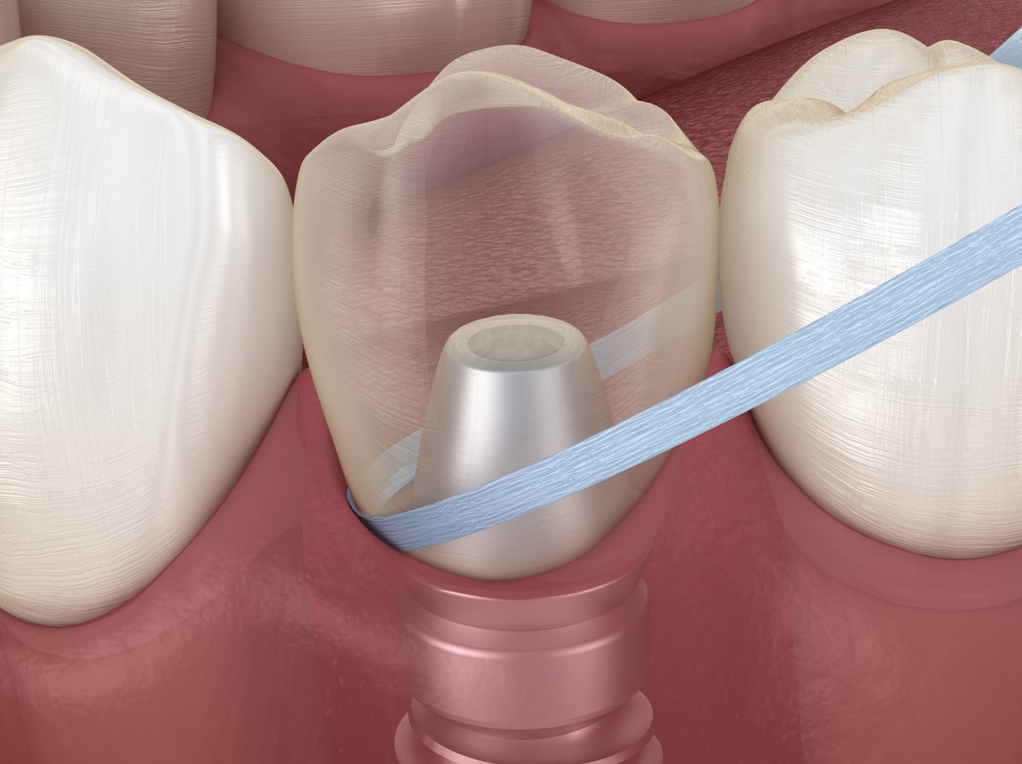 Догляд за зубними імплантами
