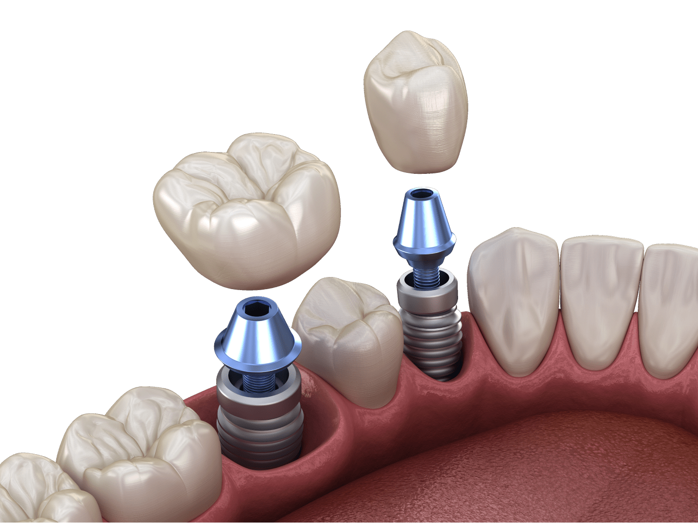 Стоматологія у розстрочку