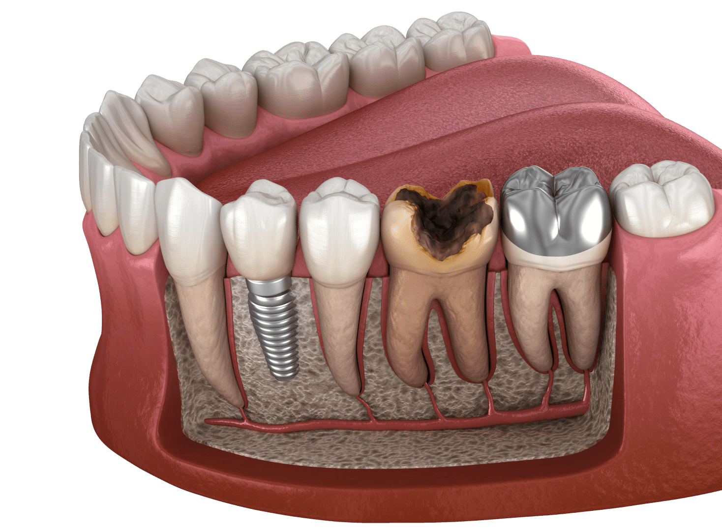 Коронка чи імплант