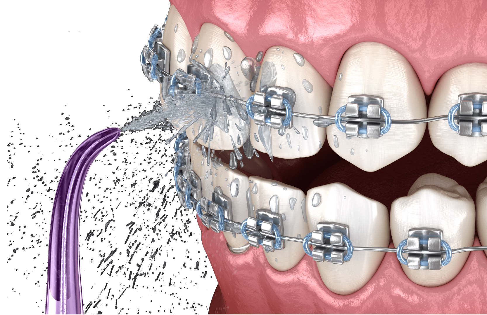 Догляд за брекетами