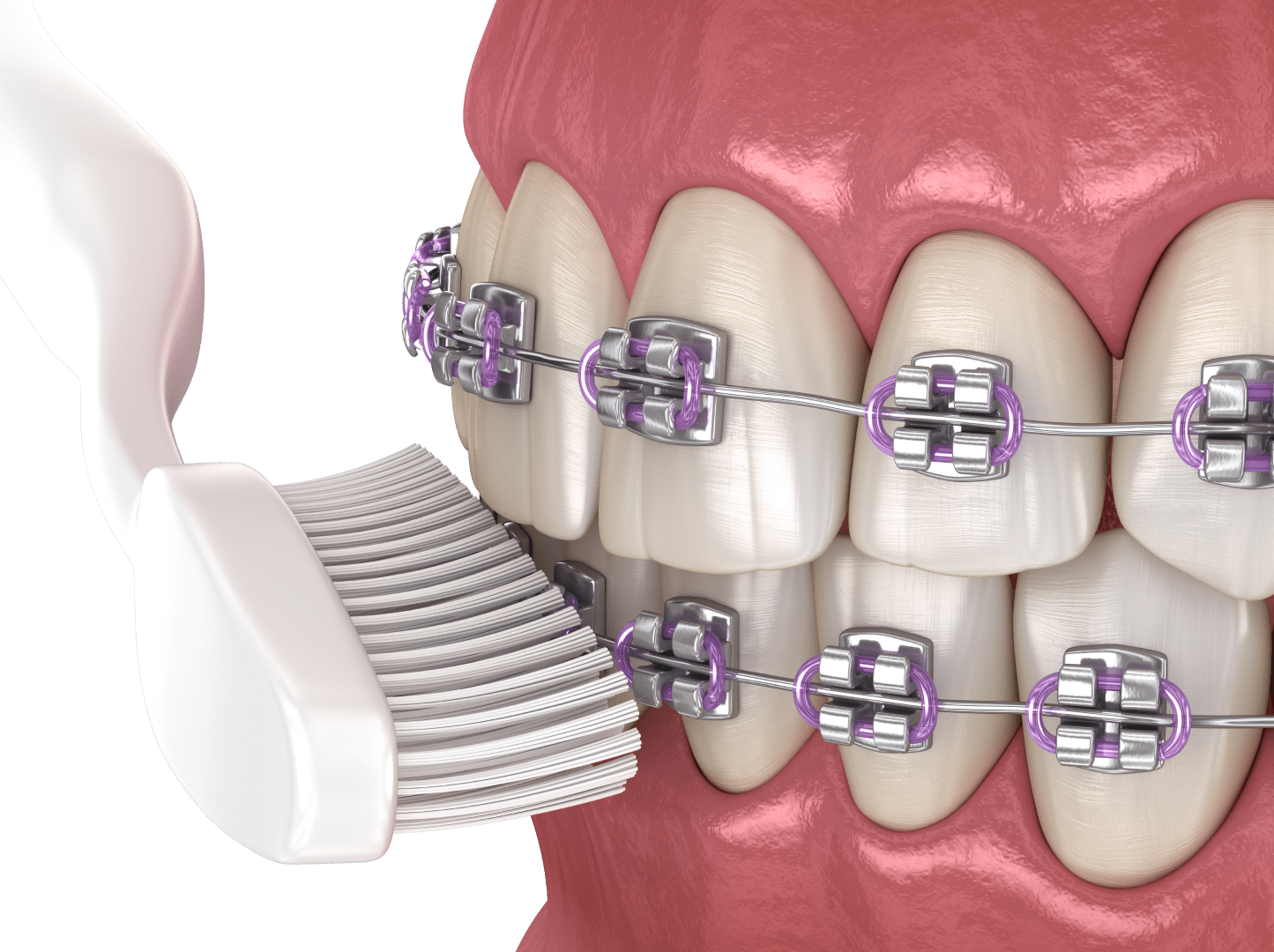 Догляд за брекетами