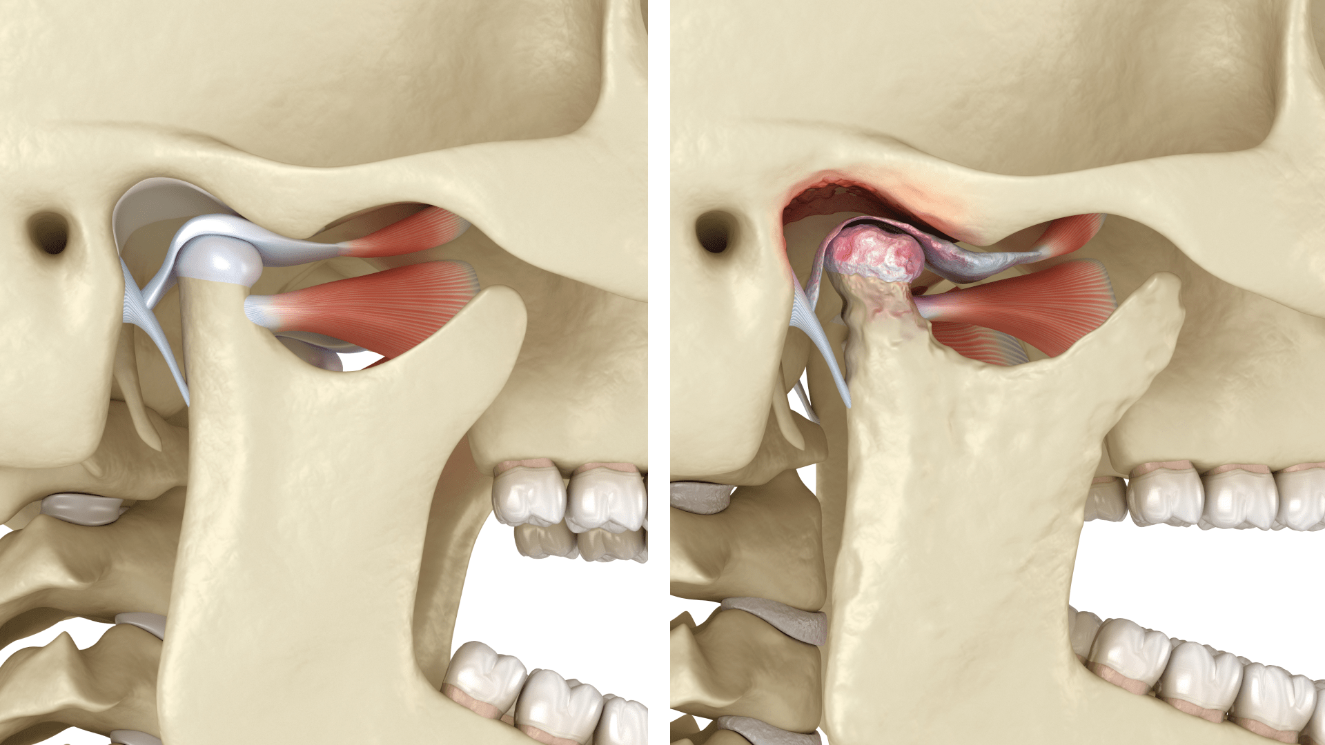 Скронево-нижньощелепний суглоб