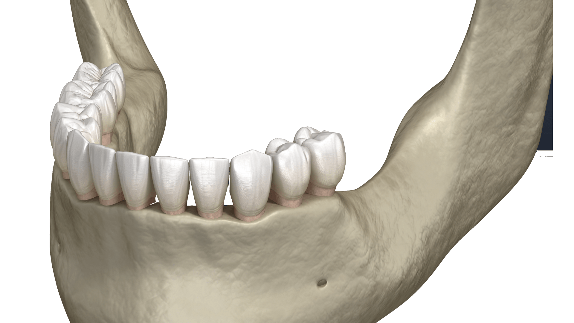 Резорбція кістки щелепи