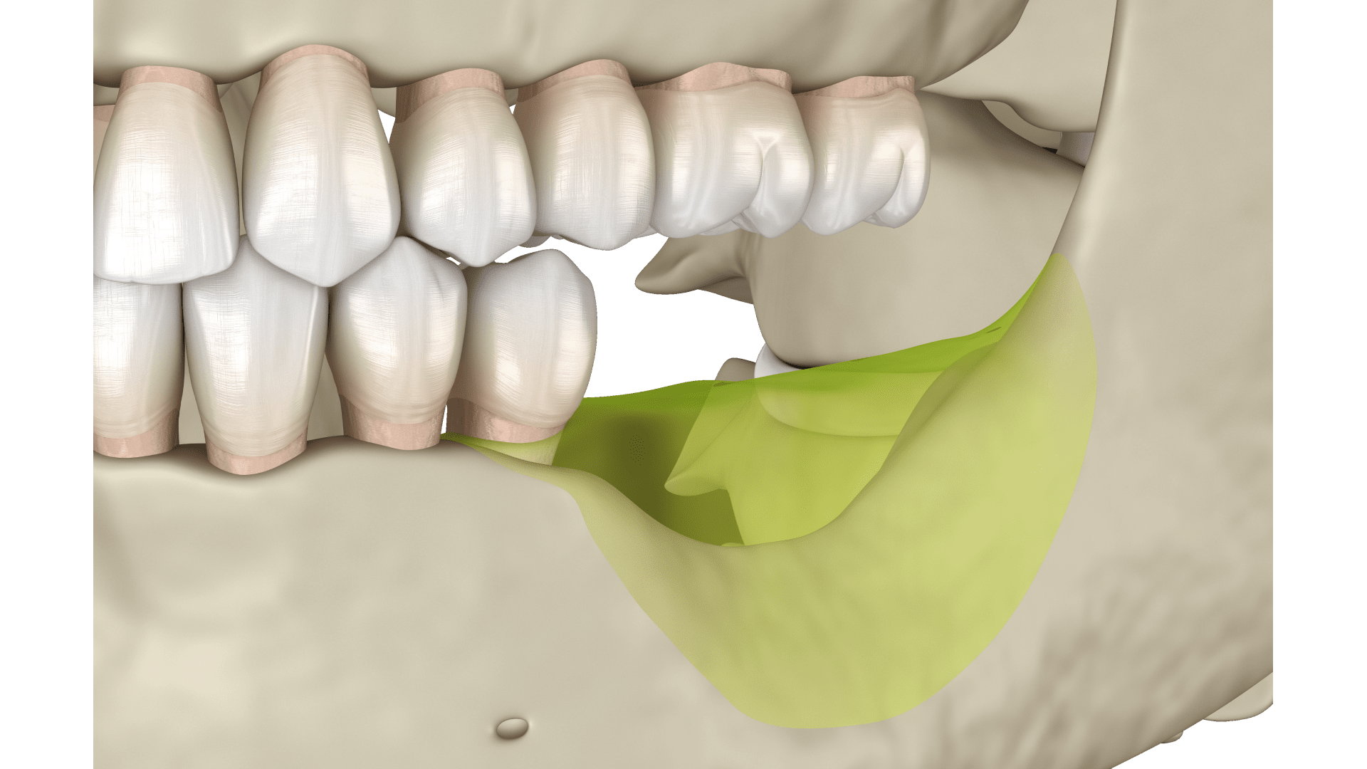 Резорбція кістки щелепи