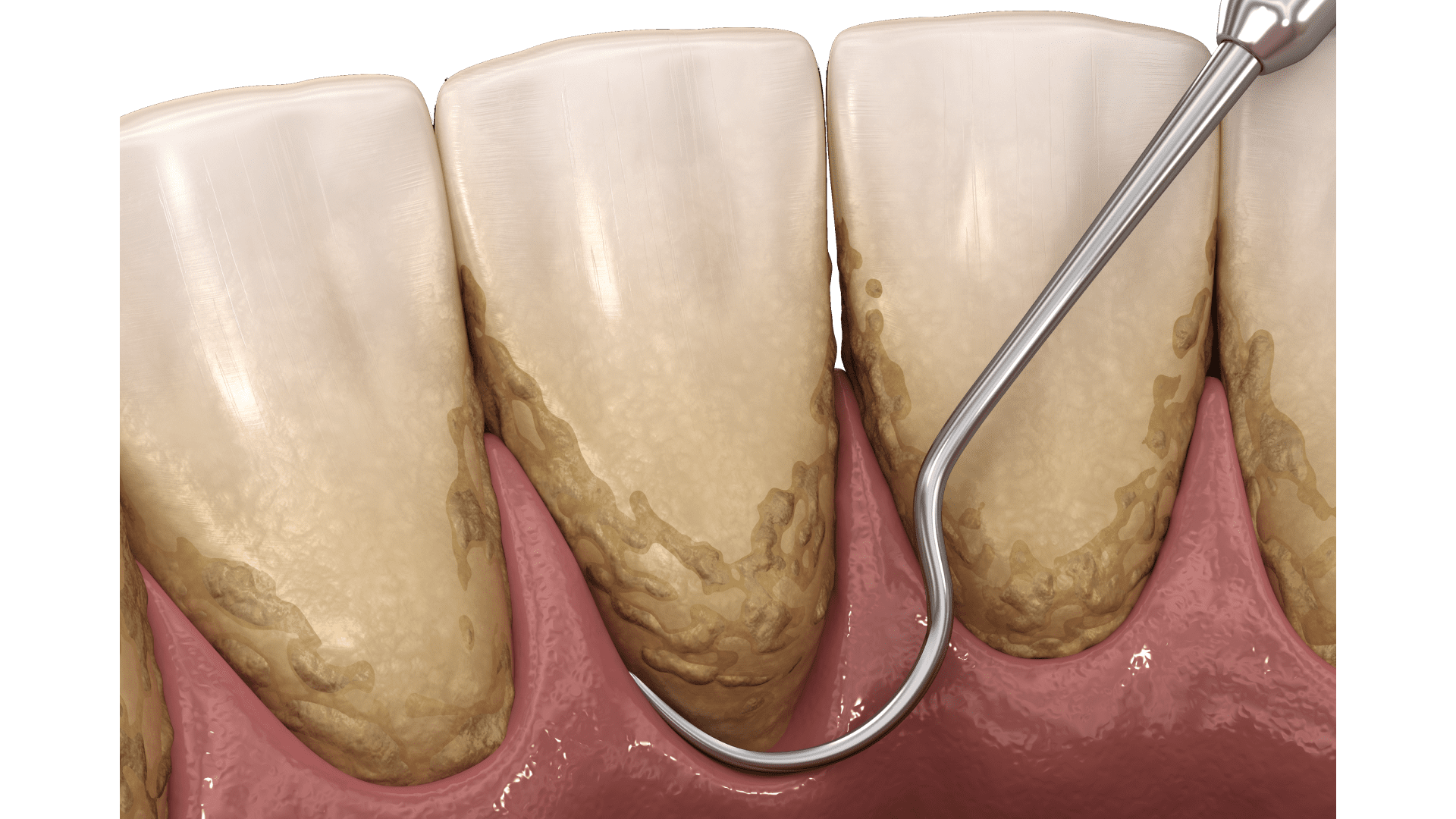Зубний камінь