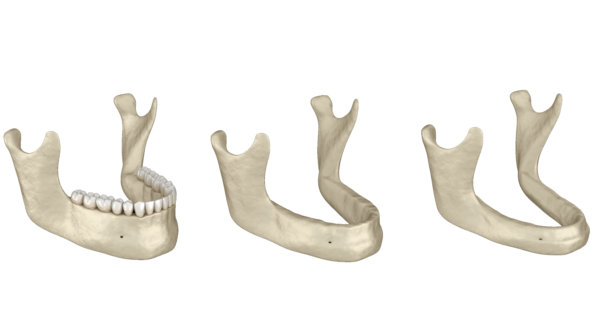 Резорбція кістки щелепи