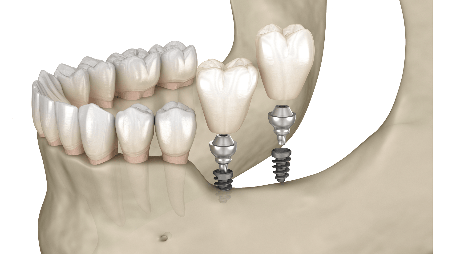 Резорбція кістки щелепи