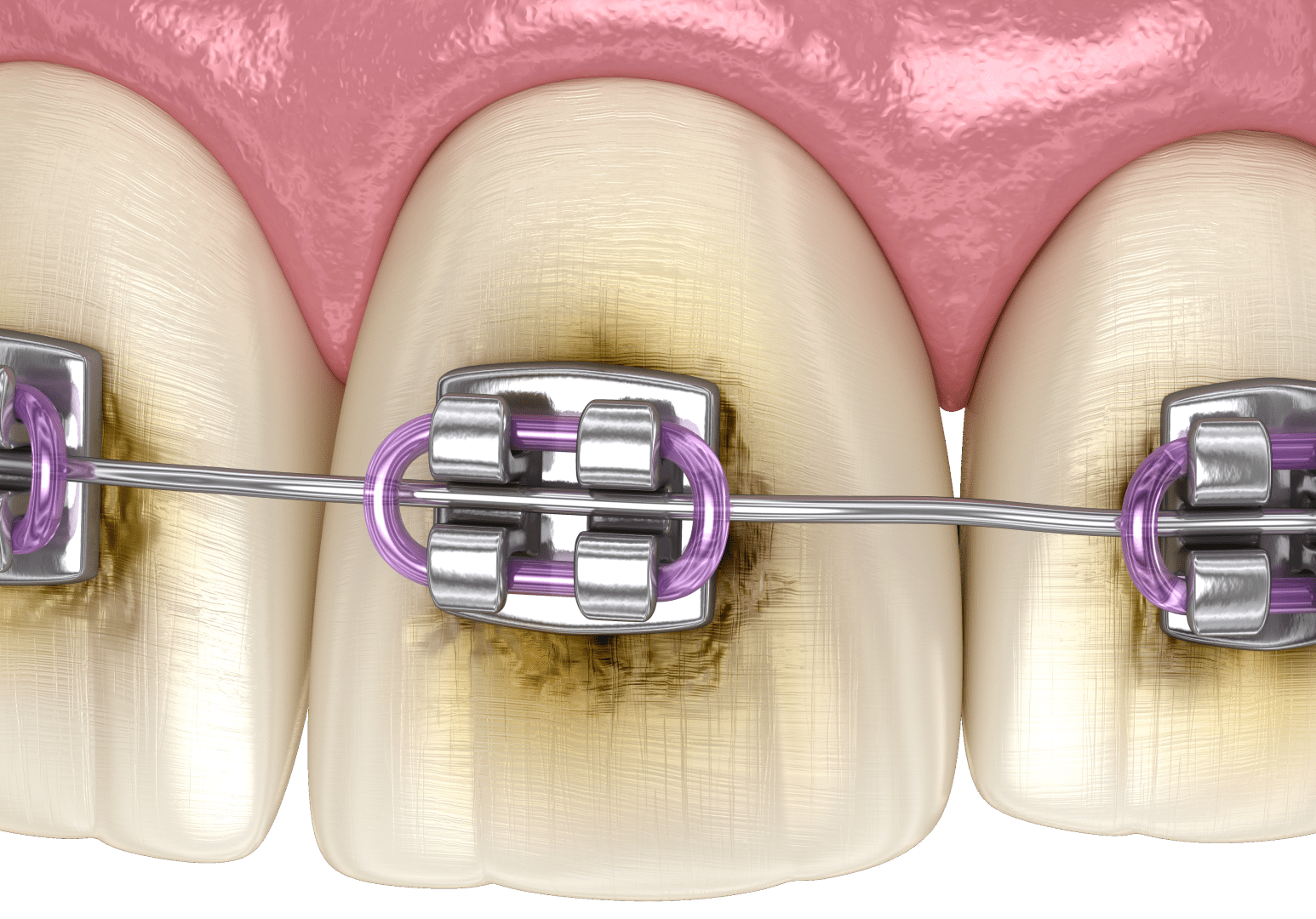 Карієс зубів