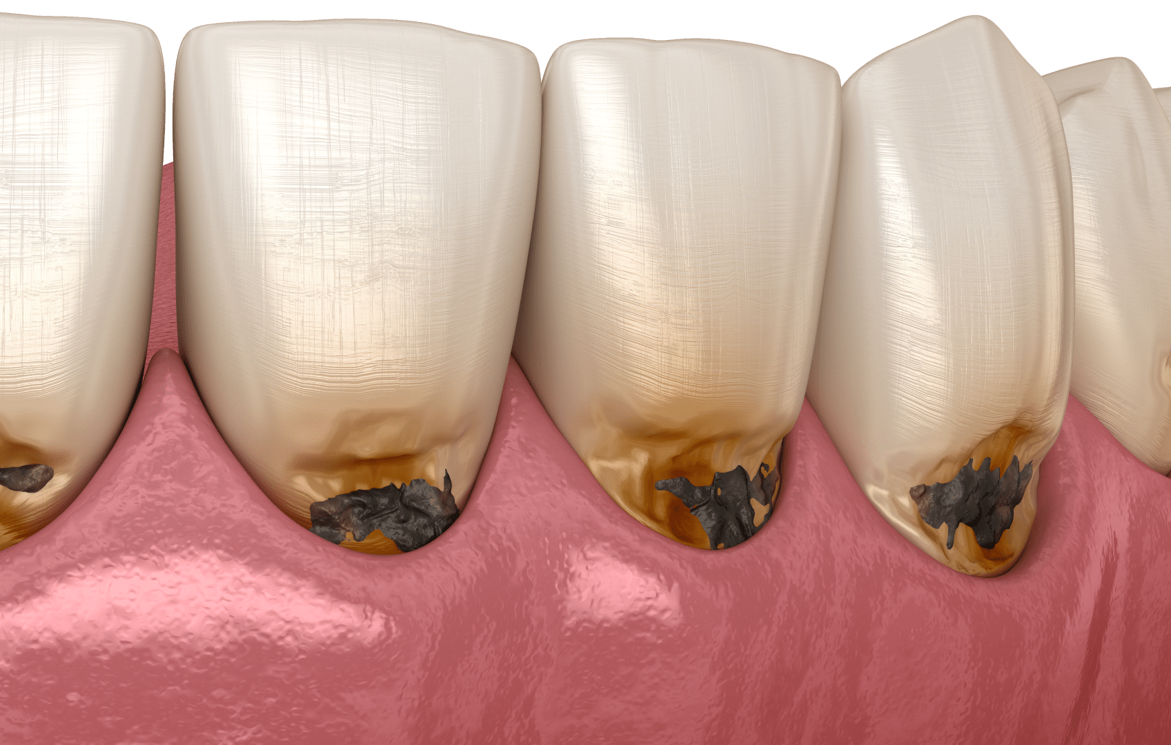Карієс зубів