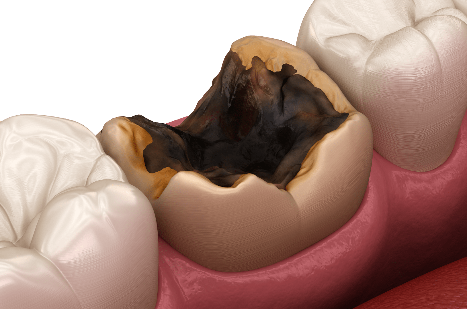 Карієс зубів