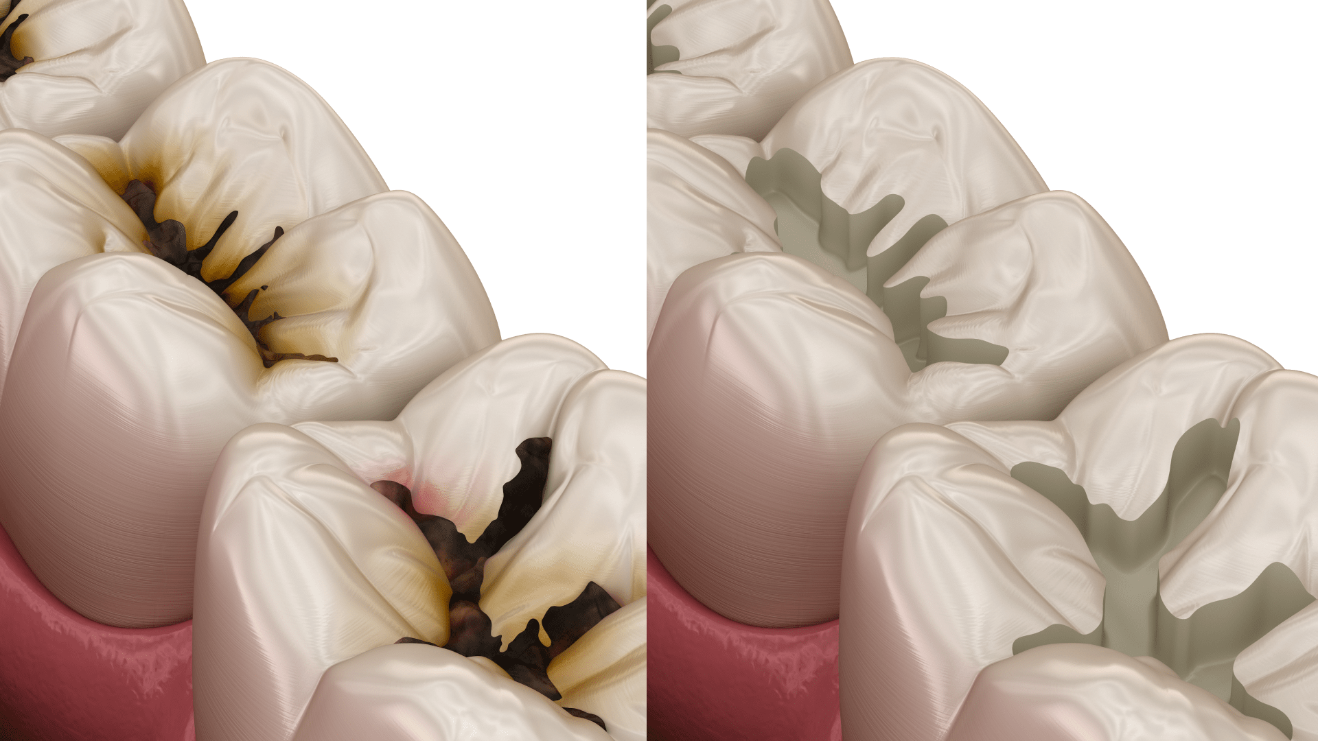 Карієс зубів